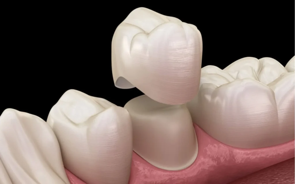 dental-crowns-and-bridges-cover.jpg