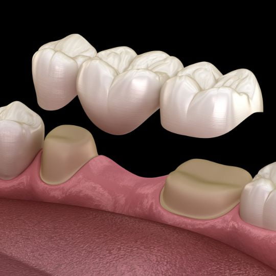 dental-crowns-and-bridges-gallery-image-1