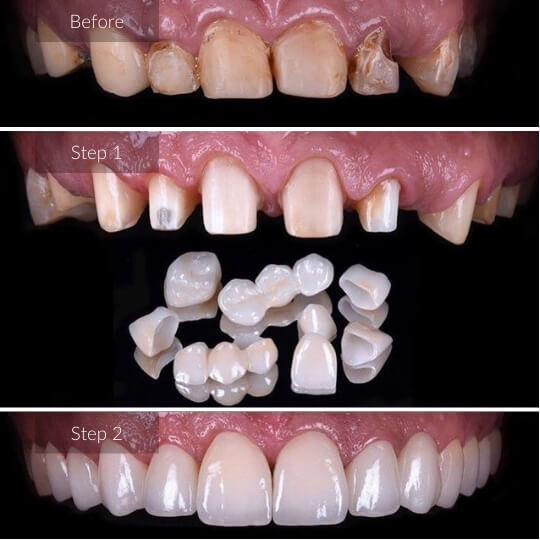 dental-crowns-and-bridges-gallery-image-2-1
