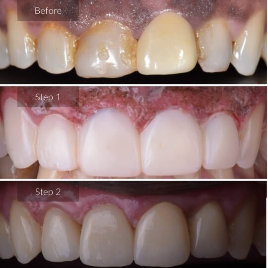 gum-treatment-gallery-image-1-1