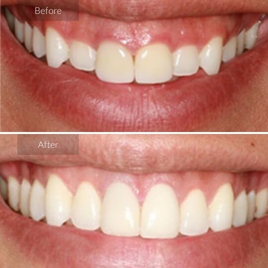 gum-treatment-gallery-image-2-1