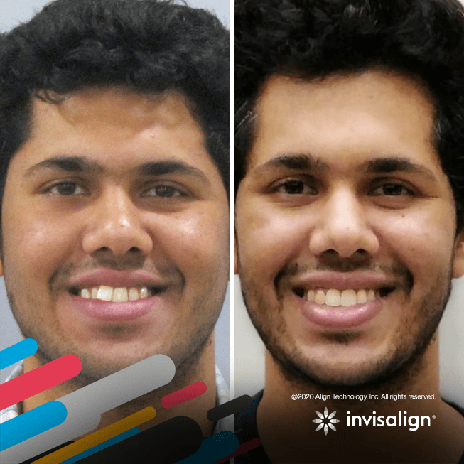 invisalign-gallery-image-1