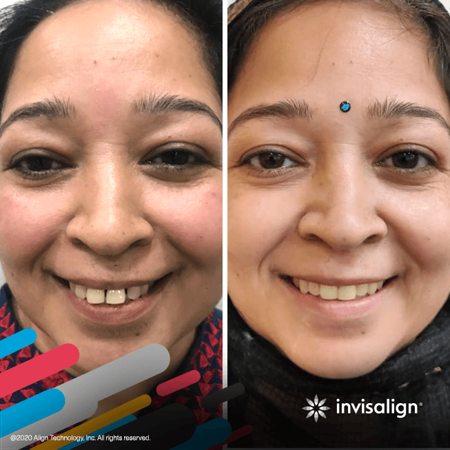 invisalign-gallery-image-2