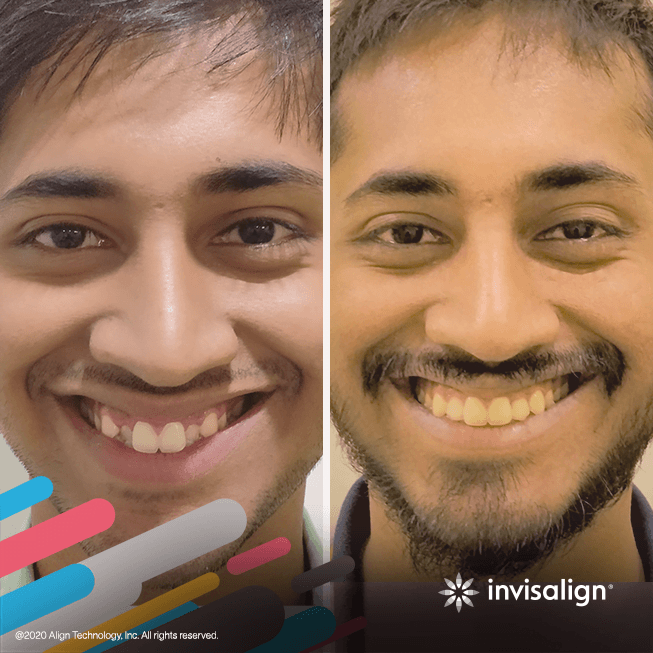 invisalign-gallery-image-3