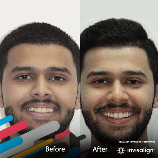 invisalign-gallery-image-4