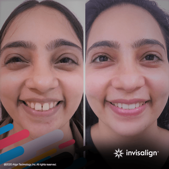 invisalign-gallery-image-5