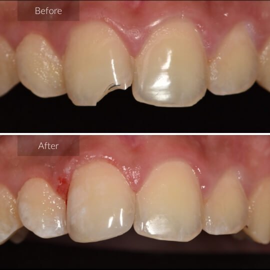 tooth-colored-fillings-gallery-image-1-1