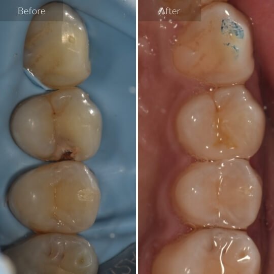 tooth-colored-fillings-gallery-image-2-1