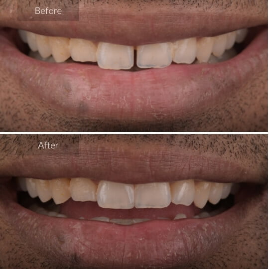 tooth-colored-fillings-gallery-image-3-1
