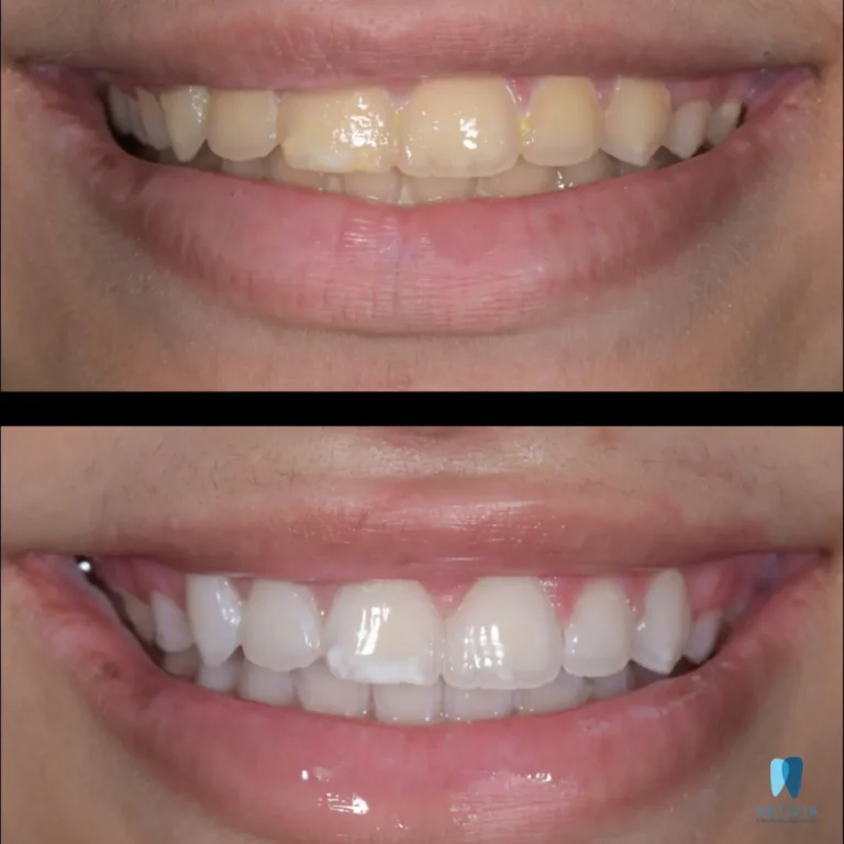 Teeth Whitening
