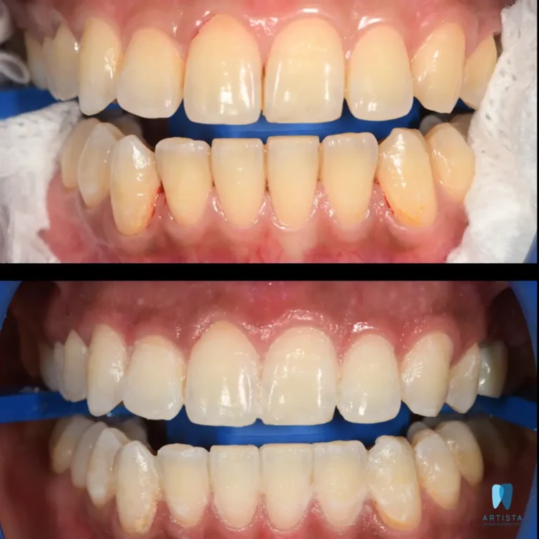 Teeth Whitening