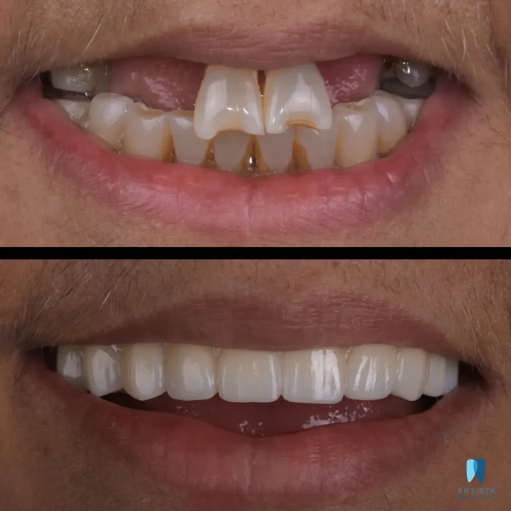Full Mouth Implants