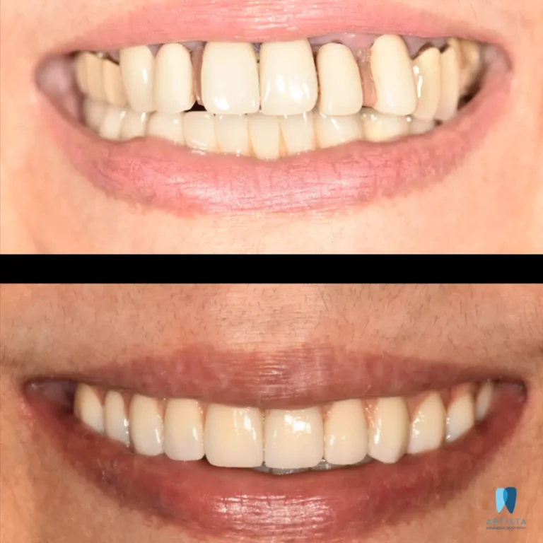 Full Mouth Implants