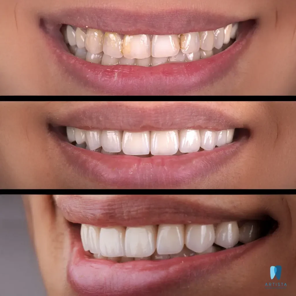 Smile Makeover with Veneers